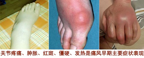 痛风的早期症状红肿热痛.jpg