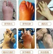 生活中预防痛风最合理的方式有哪些?