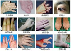 关节红、肿、热、痛？谨防类风湿性关节炎