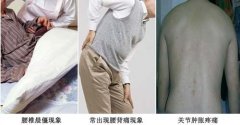 切莫忽视强直性脊柱炎早期信号：腰骶疼痛