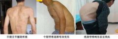 强直性脊柱炎中期症状：脊柱僵硬