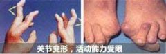 类风湿资深医生总结类风湿典型症状