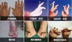 关节畸形是类风湿性关节炎晚期症状