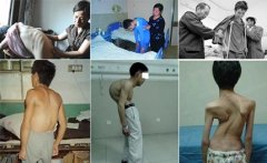 认识强直性脊柱炎症状，避免耽误治疗