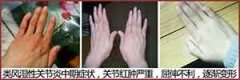 类风湿性关节炎中期有哪些症状?