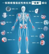 【警惕】强直性脊柱炎危害大，易致残