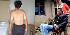 强直病人平时应该怎样保养护理？