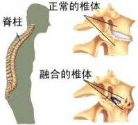 什么是周围型强直性脊柱炎?