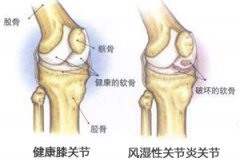 青少年患有风湿性关节炎的主要病因