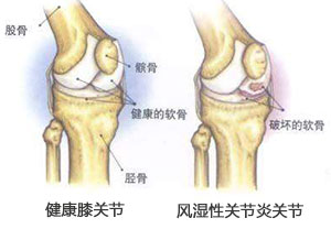 青少年风湿患者严重者已出现瘫痪残疾