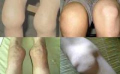 治疗风湿性关节炎，选对疗法是关键