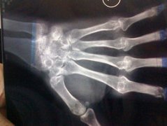 风湿性关节炎传统诊断方法