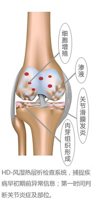 风湿膝关节2.jpg