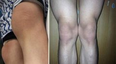 风湿性关节炎治疗存在哪些误区？