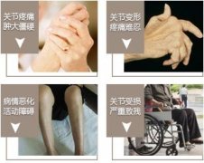 类风湿性关节炎哪些检查是必要检查?