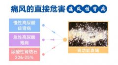重视痛风检查 提早对症治疗