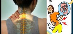 科学聚焦：颈椎病的有效治疗方法