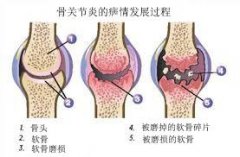 滑膜炎的预防及饮食禁忌