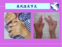 类风湿治疗技术：免疫净化治疗