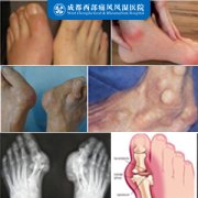 身体哪些部位是痛风常见发病部位?